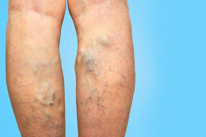 Varicose Veins Treatment in Tamil