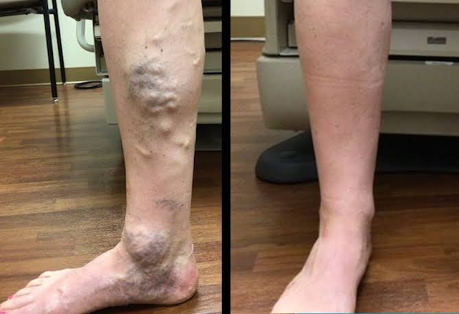Varicose Veins Treatment in Tamil